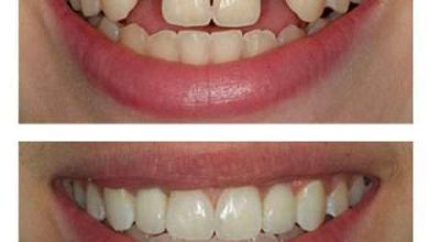 ایمپلنت دندان