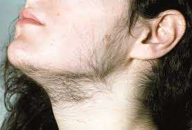 سندرم تخمدان پلی کیستک